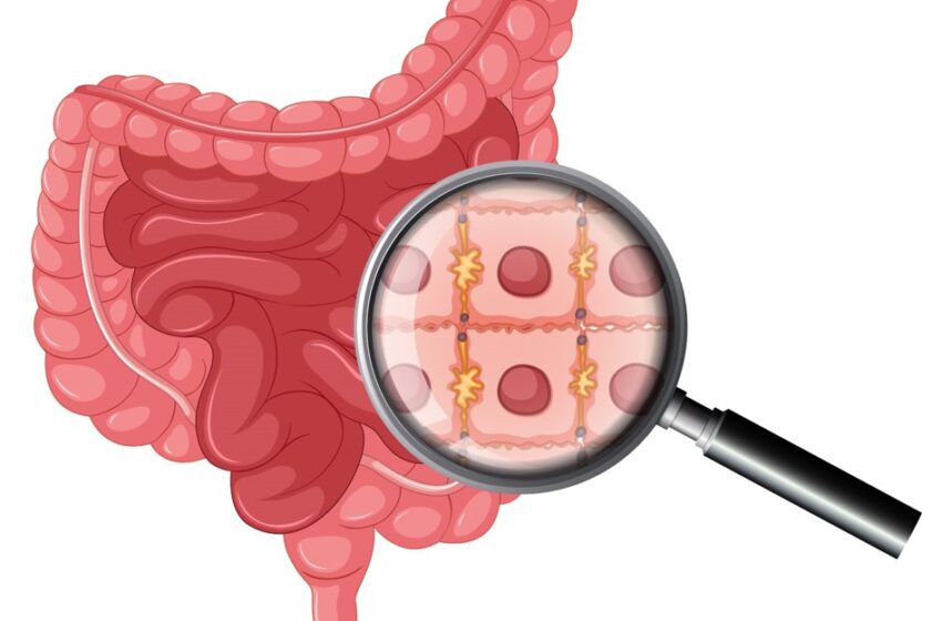  Intestinal Haemorrhage & Acute Loss of Hemoglobin – A Case